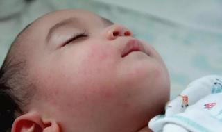 手足口病会传染大人么 手足口病会传染大人么